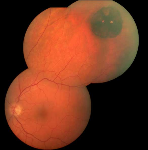 Pigmented lesion in the superotemporal retina