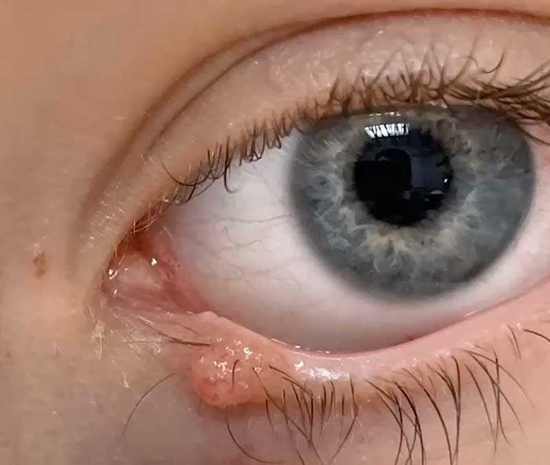 White cyst deals on eyelid