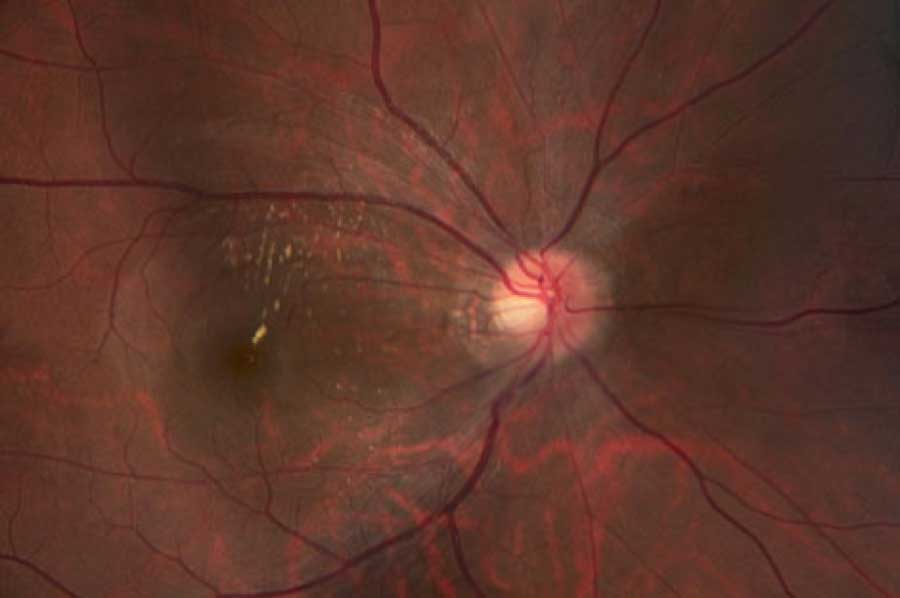 hypertensive retinopathy macular star