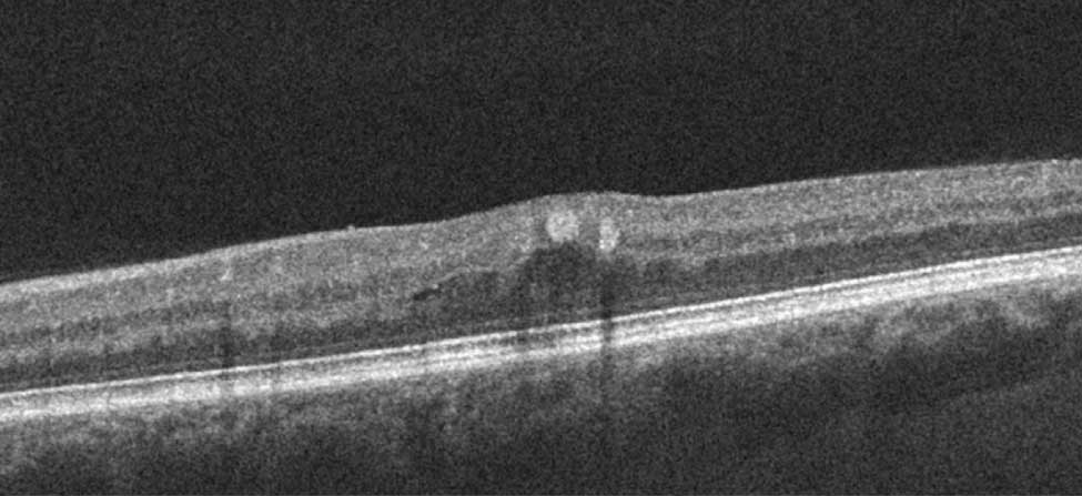 OCT of a 45-year-old with blurred vision