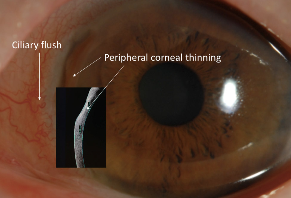 Cornea Coach #1