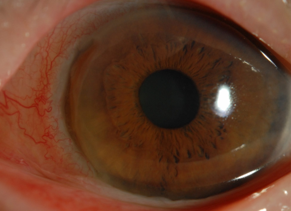 Cornea Coach #1