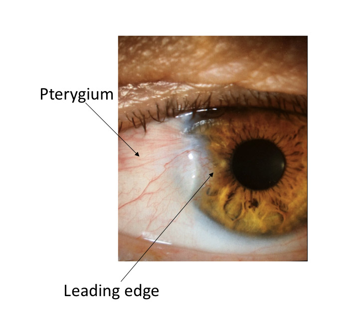 Cornea Coach #2 Analysis