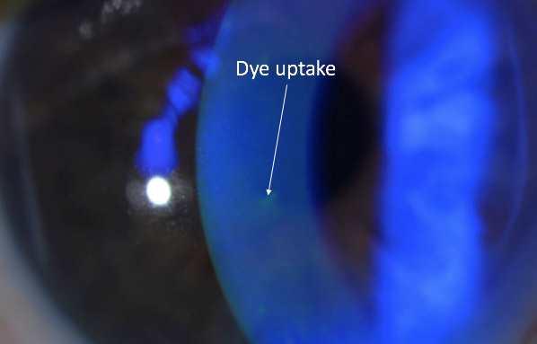 Cornea Coach #3 Analysis