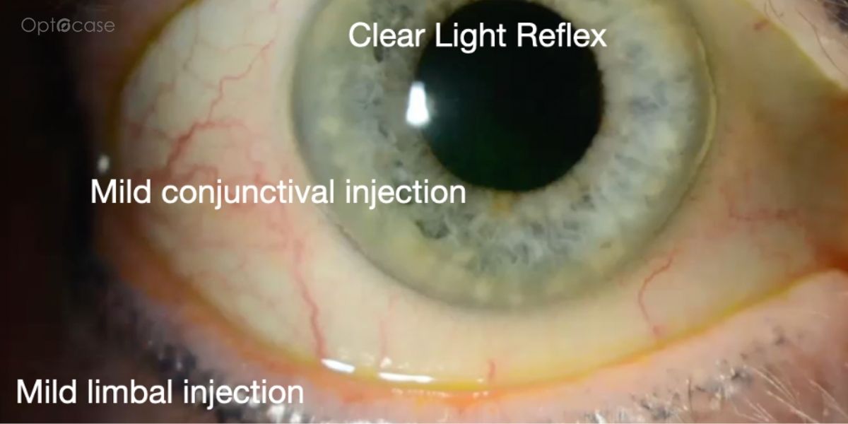 Cornea Coach #20 Analysis