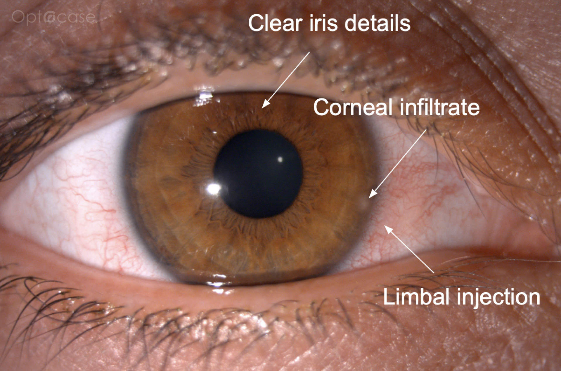 Cornea Coach #22 Analysis