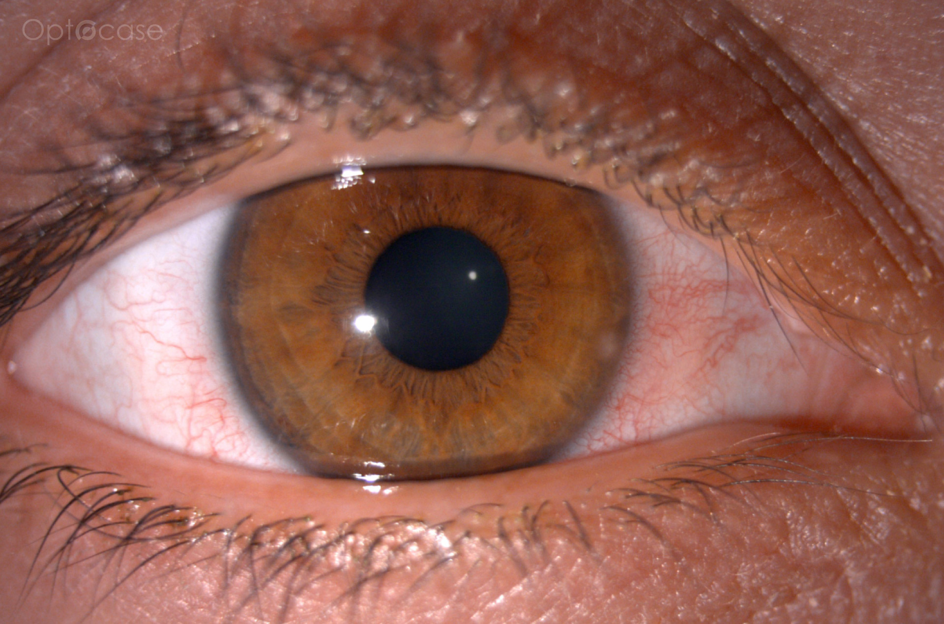 Cornea Coach #22