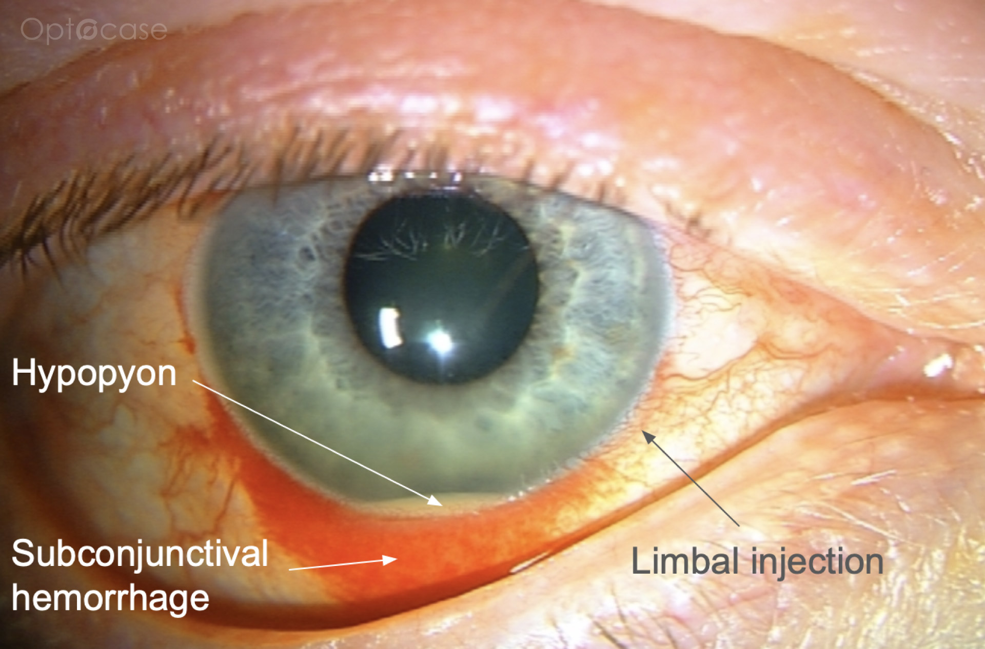 Cornea Coach #26 Analysis
