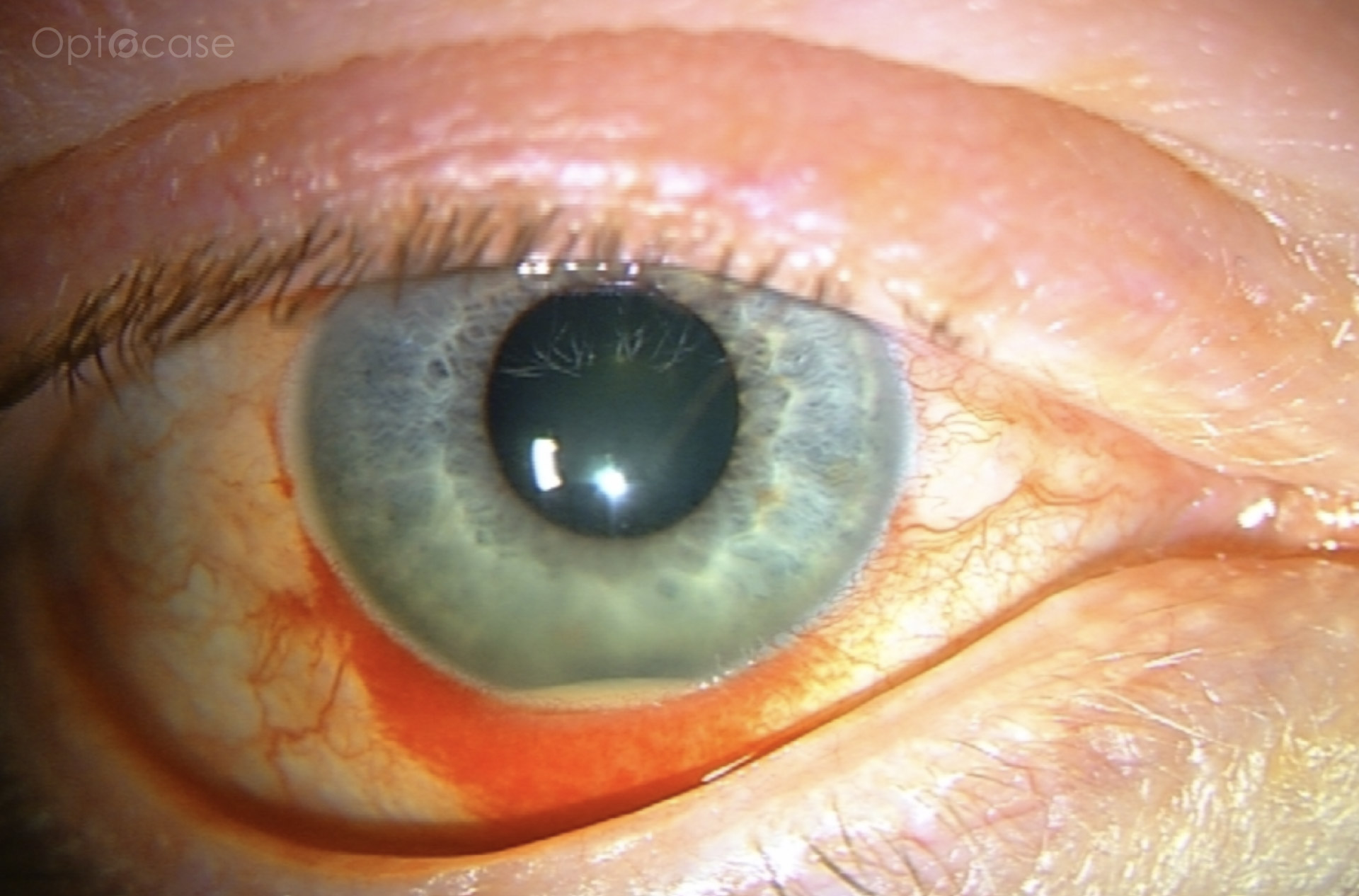 Cornea Coach #26