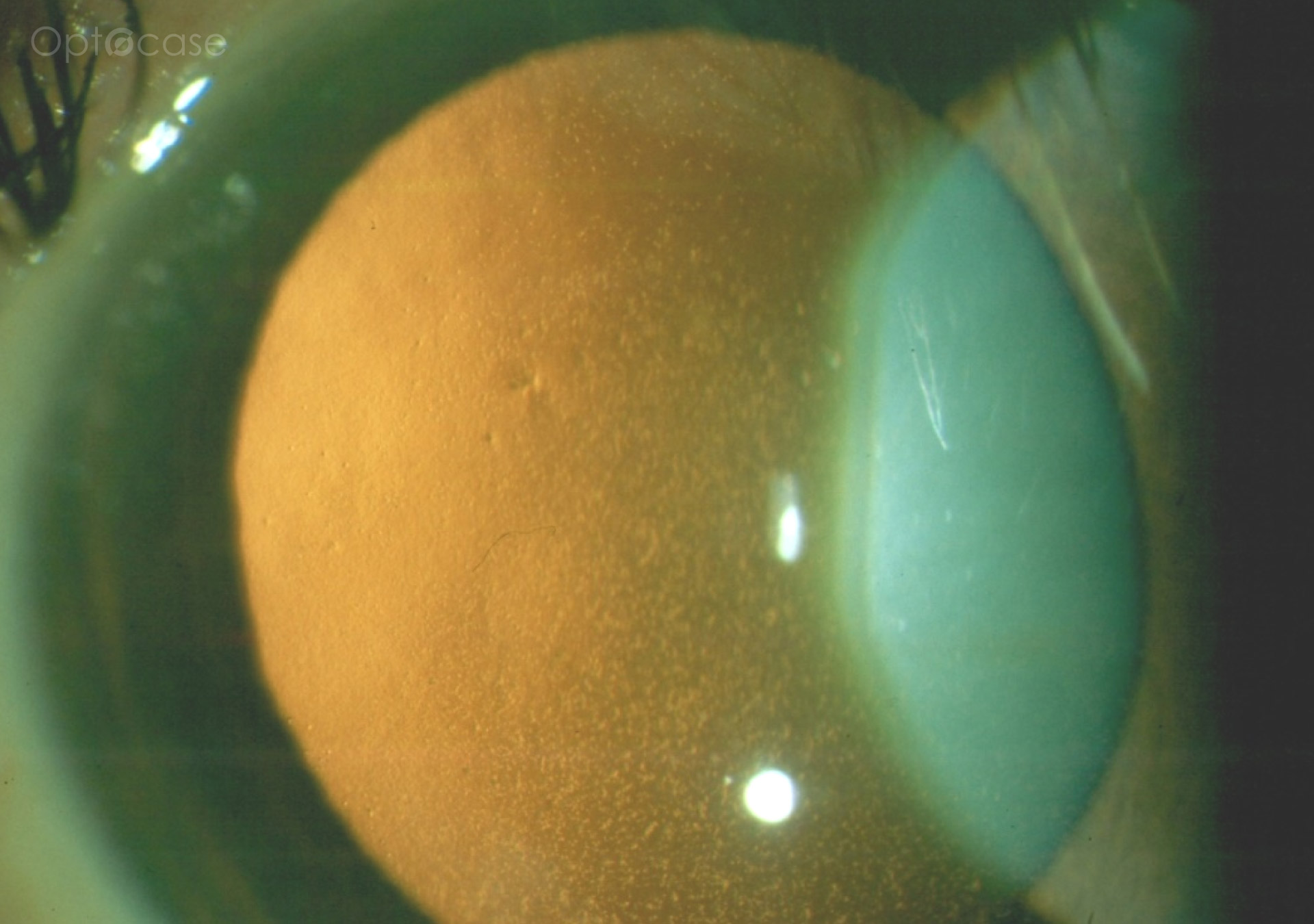 Cornea Coach #26