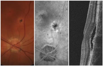 Ocular Histoplasmosis Syndrome (OHS) with Choroidal Neovascularization (CNV)