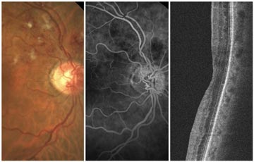 Case 22: Retinal Vein Occlusion