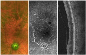 Central Retinal Vein Occlusion (CRVO) with Neovascular Glaucoma (NVG)