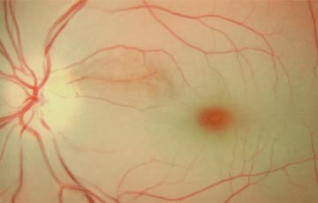 Central Retinal Artery Occlusion (CRAO)