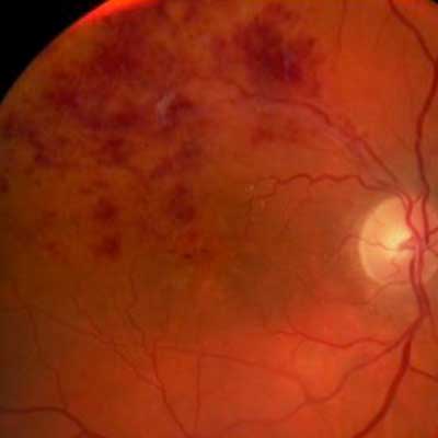 Retinal Vein Occlusion