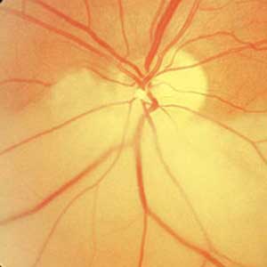 An Update on Retinal Artery Occlusion