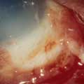 Chemical Ocular Injury