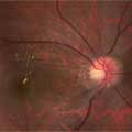 Hypertension and the Eye
