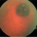 A Pigmented Lesion in a 40-Year-Old