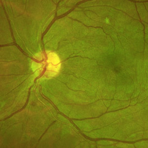 15 Retina Cases Every Optometrist Needs to Know