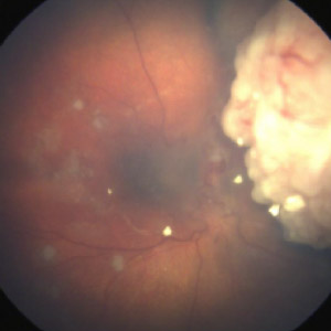 Retinoblastoma: Current Approach to Management