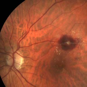 Review of Retinal Artery Macroaneurysm