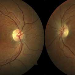 Update on Giant Cell Arteritis