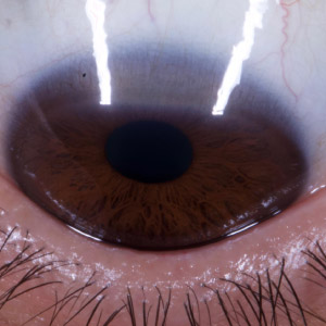 Must Know Cornea Cases