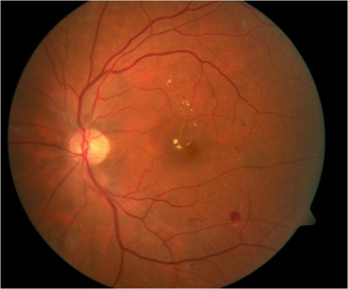 A 43-year-old male presents to your clinic for his annual diabetic eye exam.