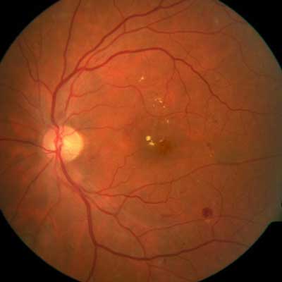 Diabetic Macular Edema