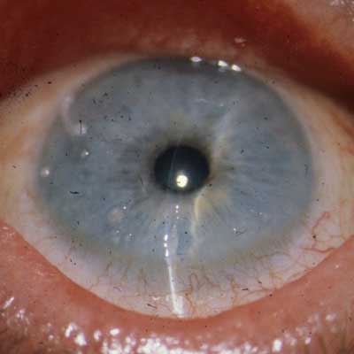 Dry Eye