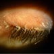 Chronic Eyelid Irritation