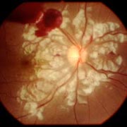 Sudden Visual Loss: Purtscher's Retinopathy