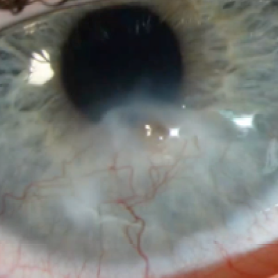 Ocular Surface Diseases in Children
