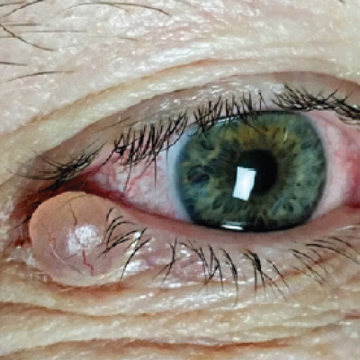 Eyelid Lumps & Bumps: The Good, The Bad, and the Ugly