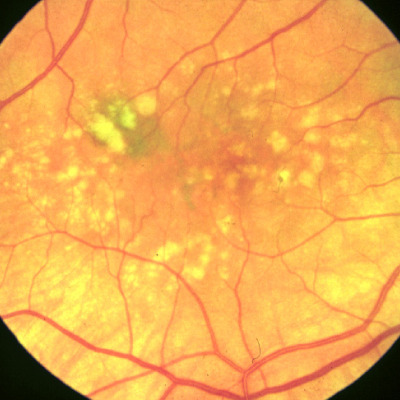 The Many Faces of Dry/Atrophic Macular Degeneration