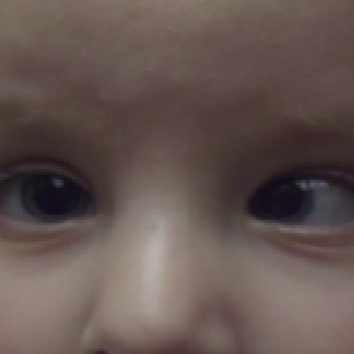 Refractive Errors in Kids - Do's and Don'ts