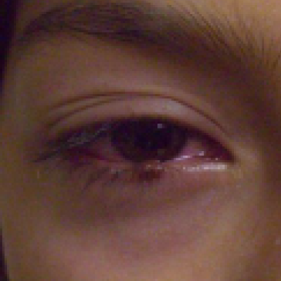 Pediatric Pink Eye