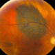 Small Choroidal Melanoma