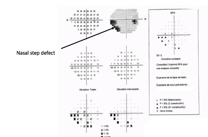 Glaucoma Coach #1 Analysis