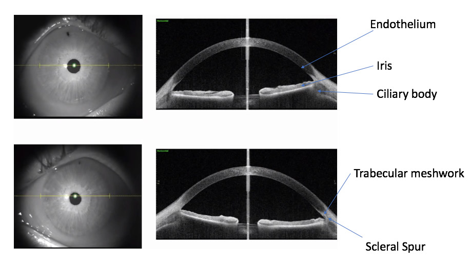 Glaucoma Coach #4 Analysis