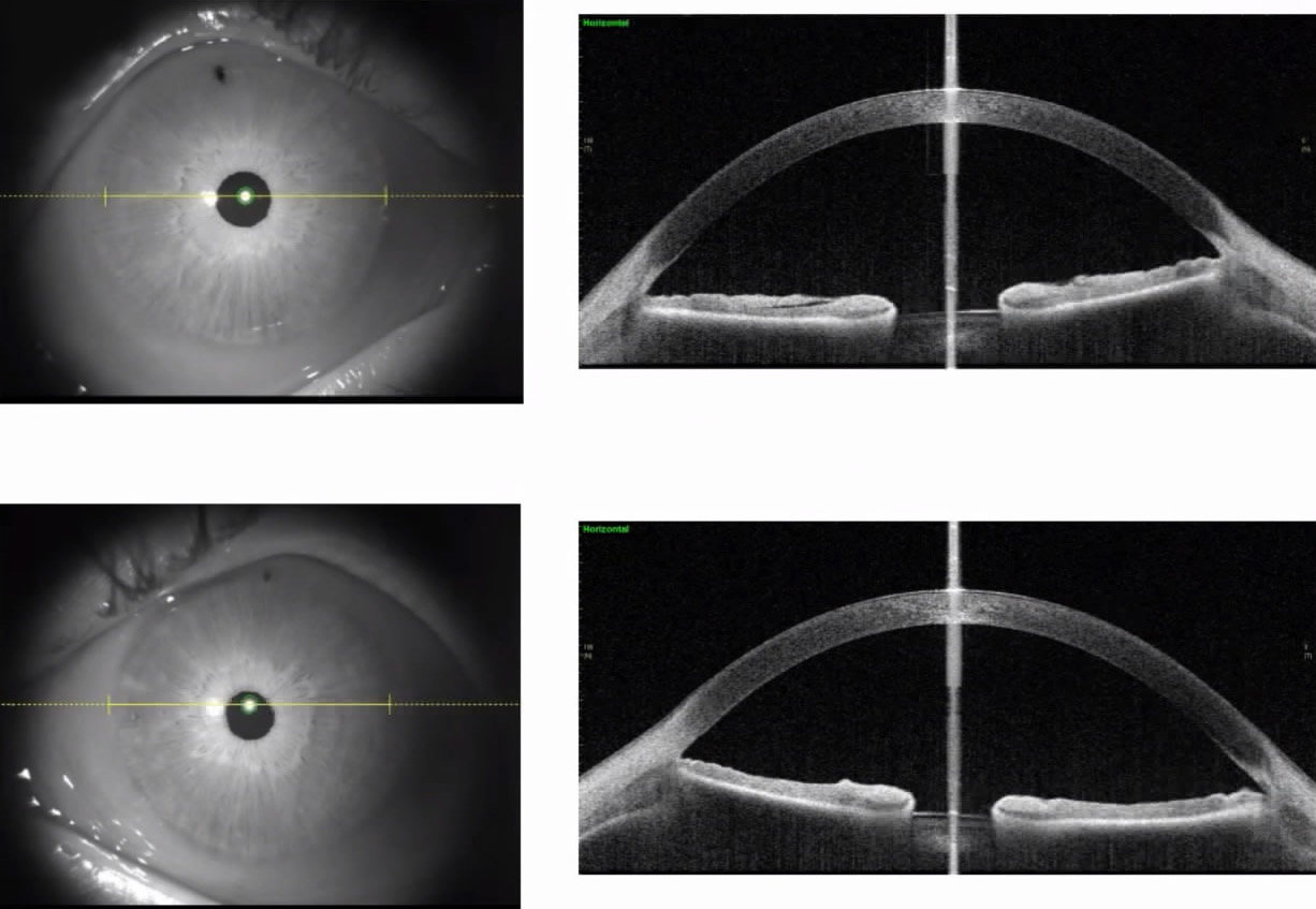 Glaucoma Coach #4