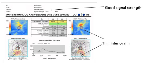 Glaucoma Coach #5 Analysis