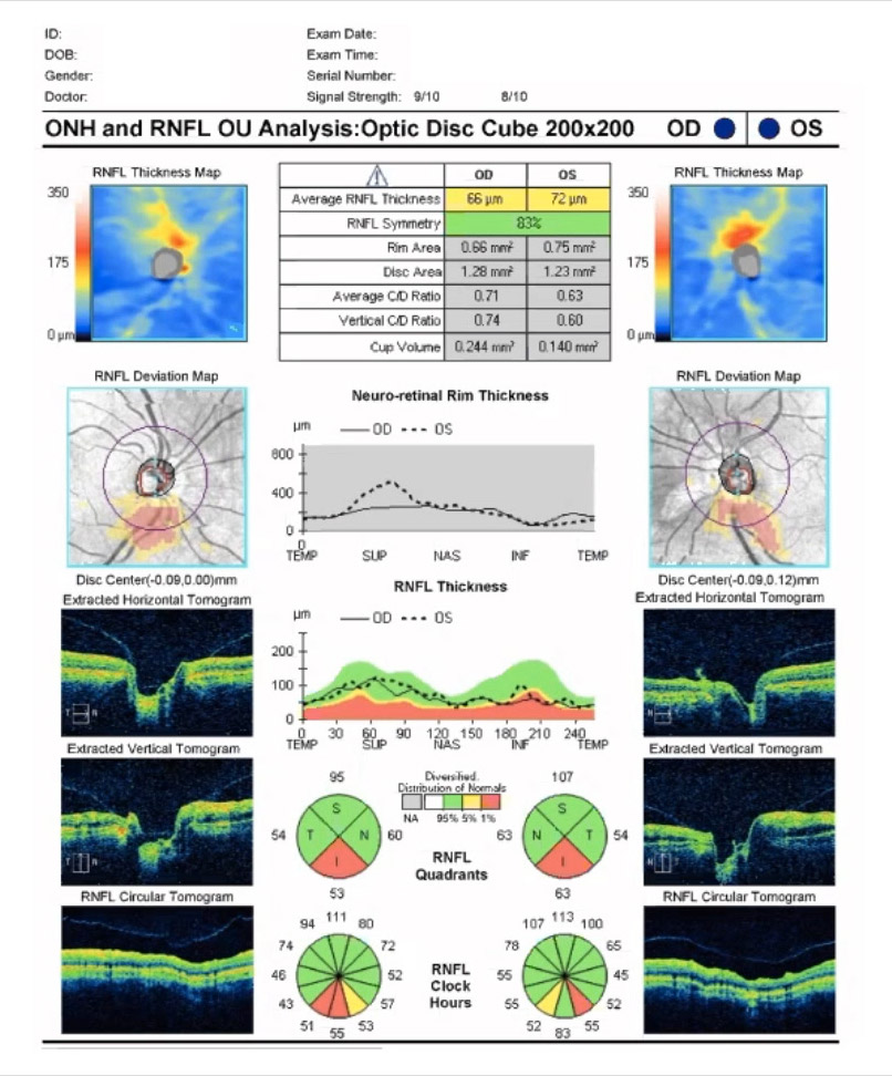 Glaucoma Coach #5
