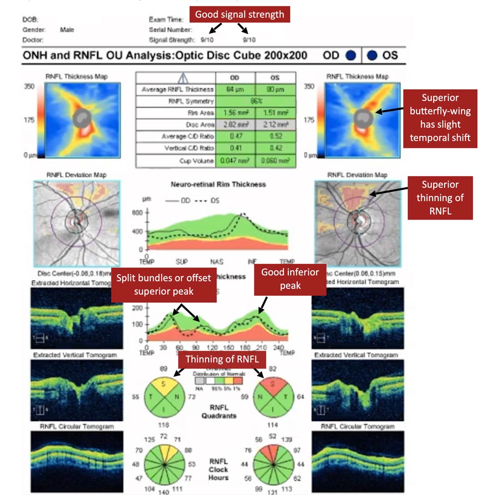 Glaucoma Coach #7 - Figure 1 Analysis