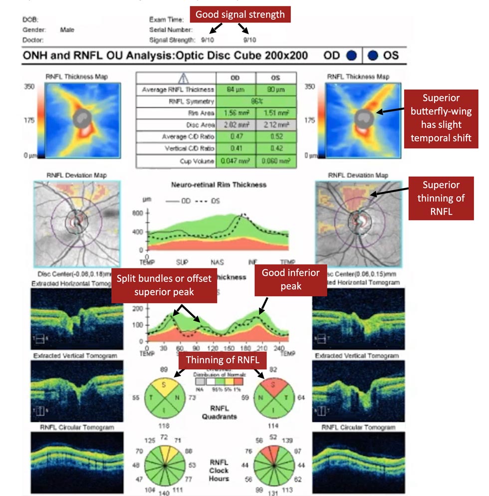 Split bundles in RNFL thickness analysis - OPTOCASE