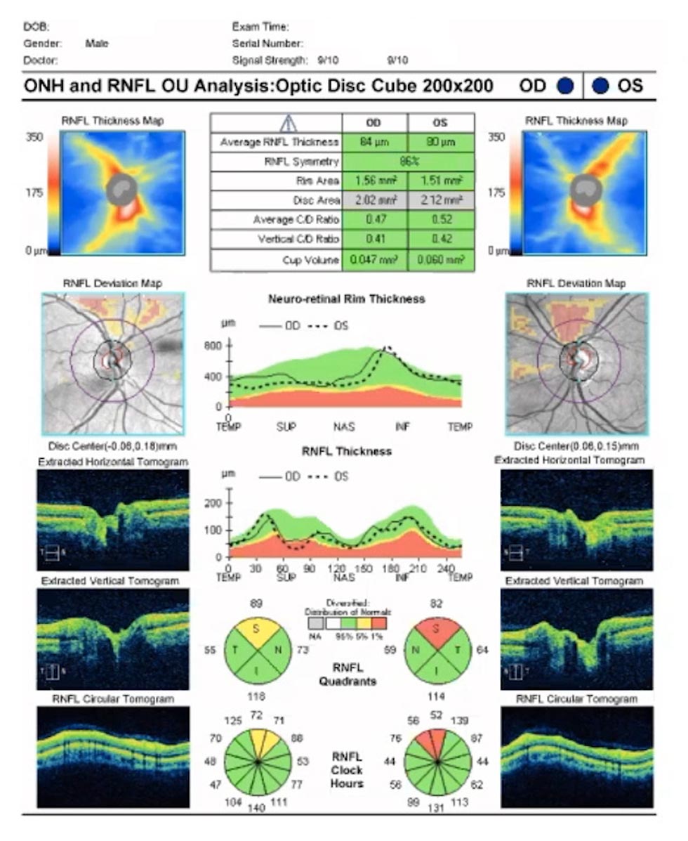 Glaucoma Coach #7 - Figure 1