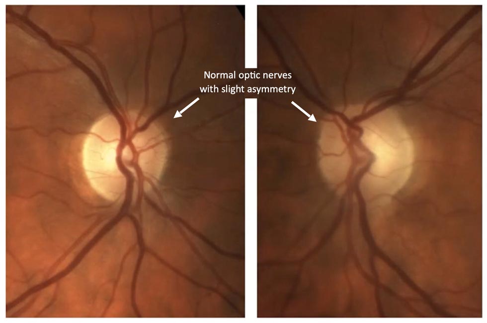 Glaucoma Coach #7 - Figure 2 Analysis