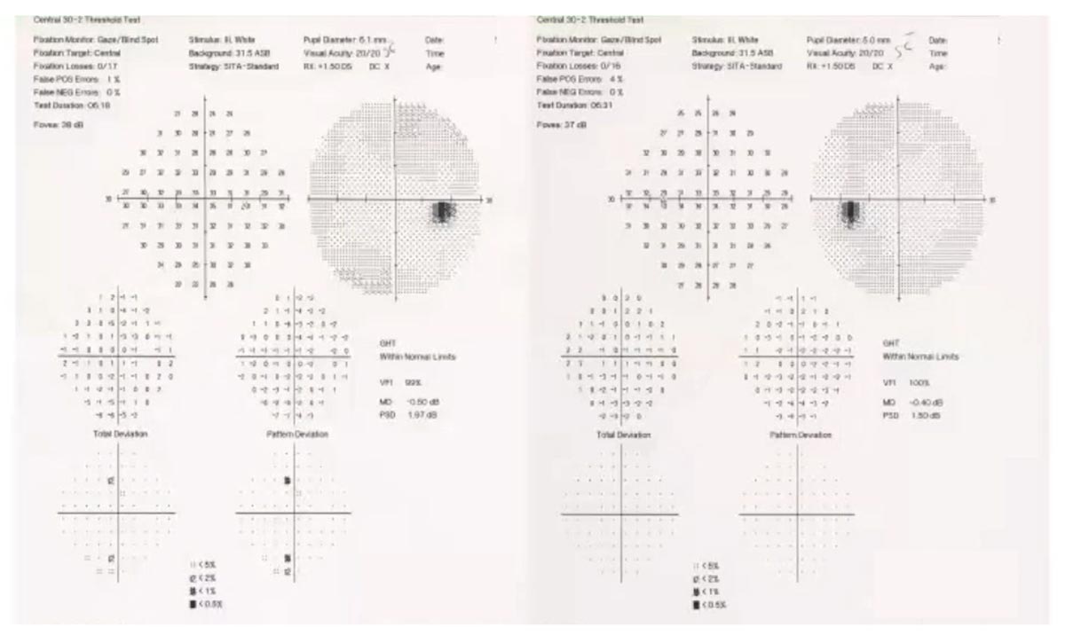 Glaucoma Coach #7 - Figure 3 Analysis
