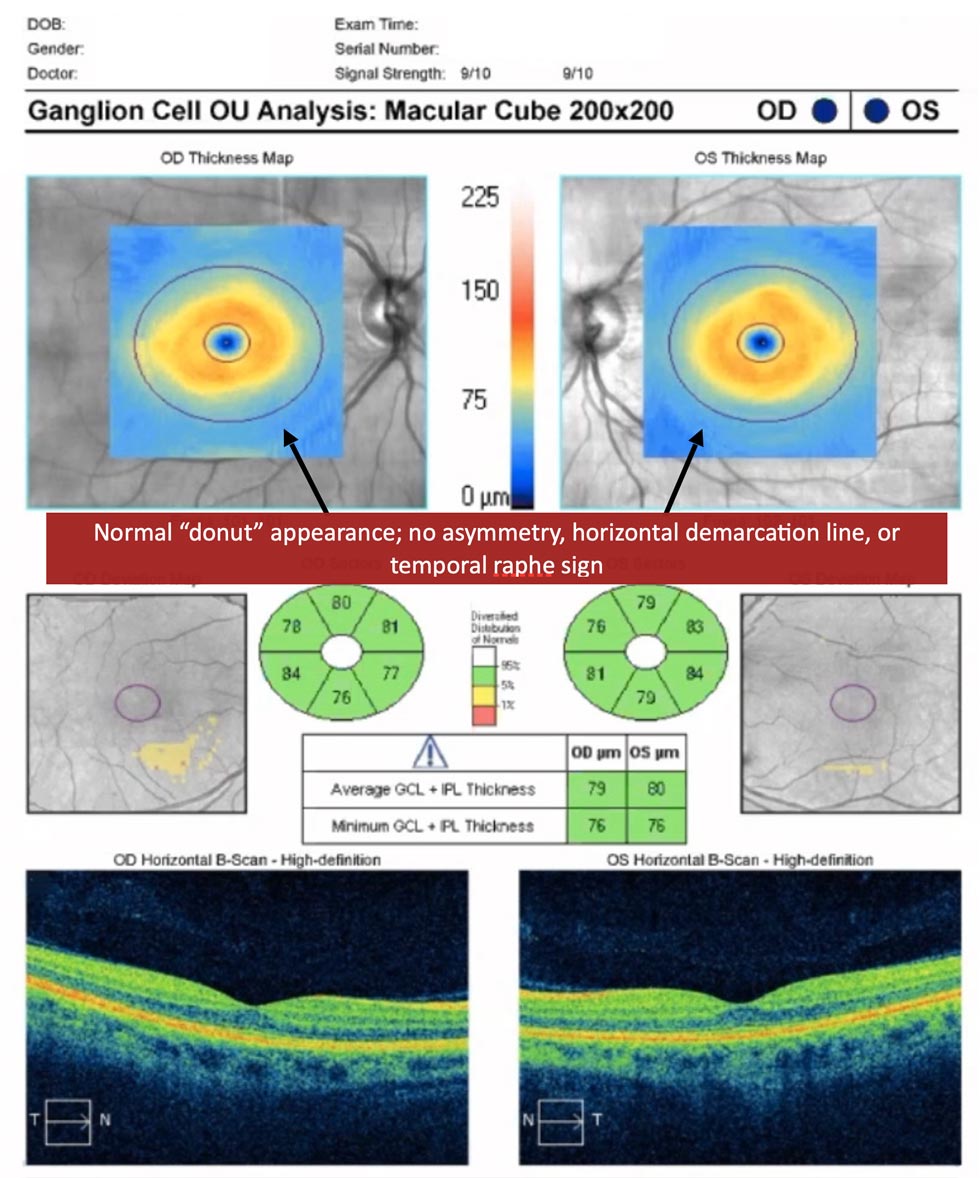 Split bundles in RNFL thickness analysis - OPTOCASE